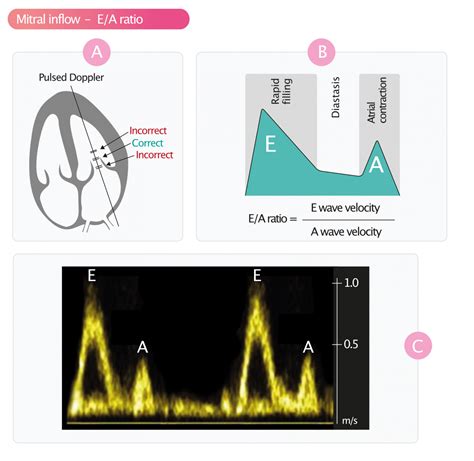 ev lv|e e' ratio echo explained.